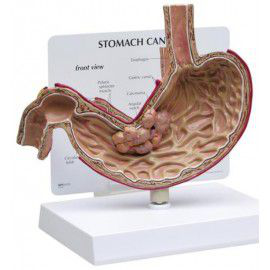 Maqueta de Estómago con Cáncer GPI Anatomical 1019524