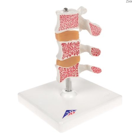 Modelo de osteoporosis – Versión de Lujo (3 Vertebrales) - 3B Smart Anatomy / 3B Scientific / 1000153 [A78]