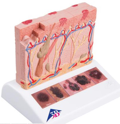 Maqueta Cáncer de Piel 3B Scientific 1000293[J15]