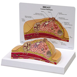 Maqueta Transversal de Mama con Patologias (cáncer) Comunes 3bscientific 1019559 [W33351]