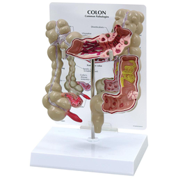 MAQUETA DE CÁNCER DE COLON